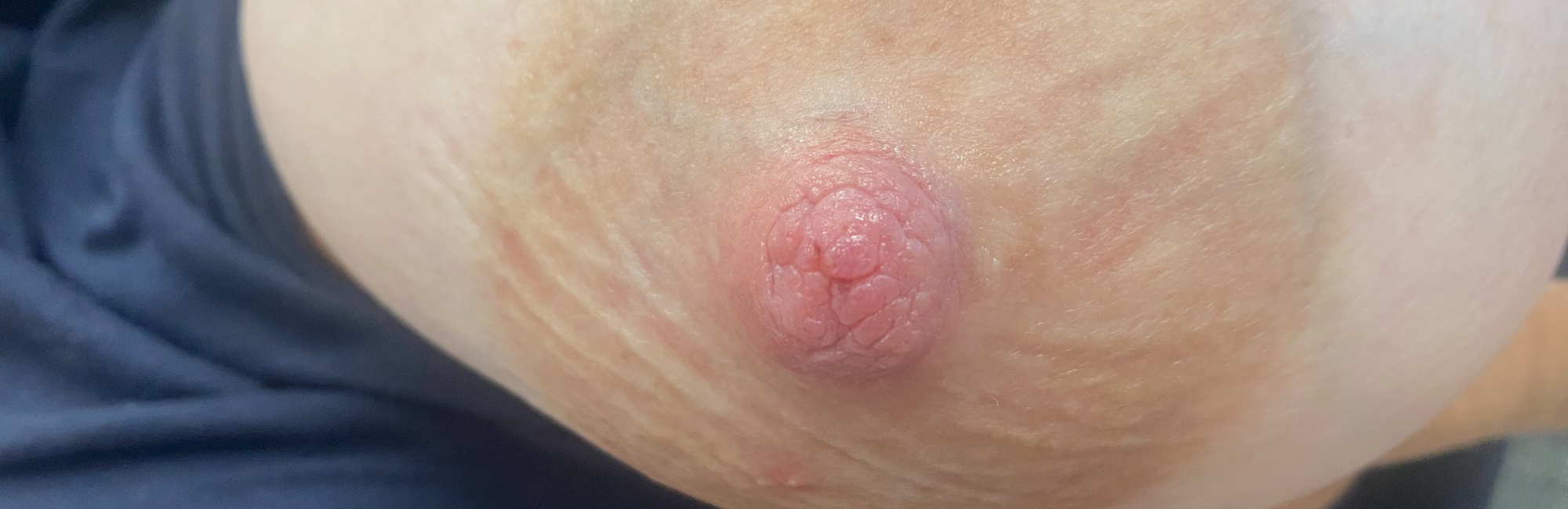 Nipple inflammation and cracks breastfeeding woman