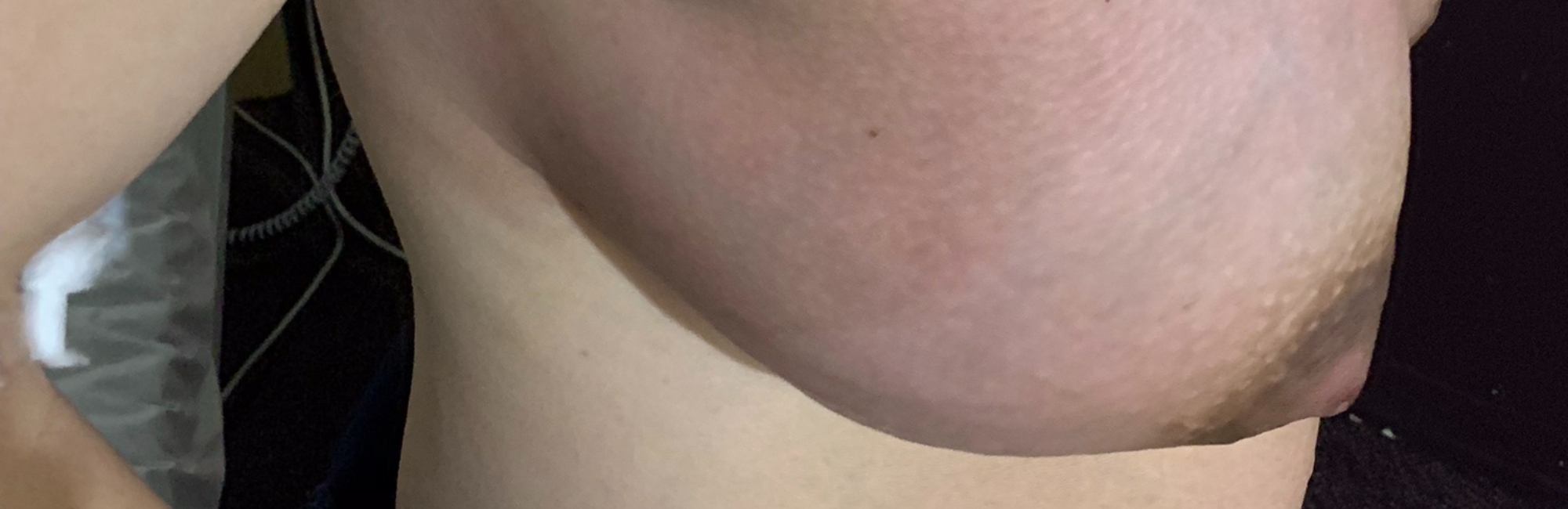 breast inflammation; lactation; breastfeeding; mastitis