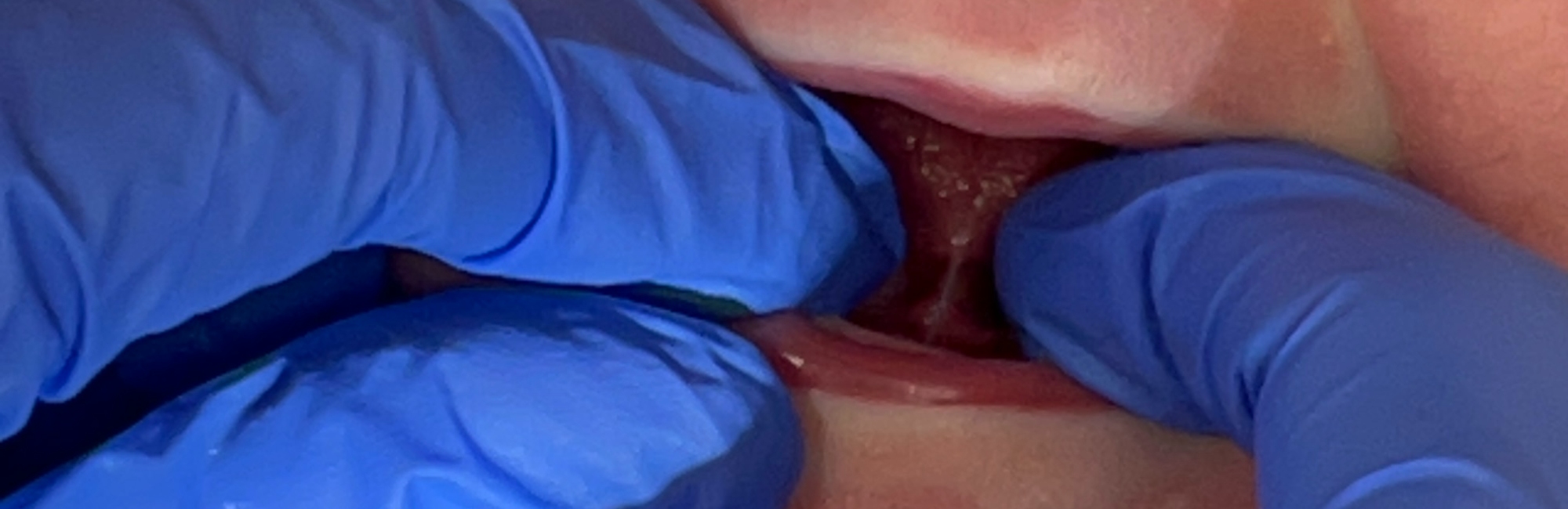 Tongue-tie assessment