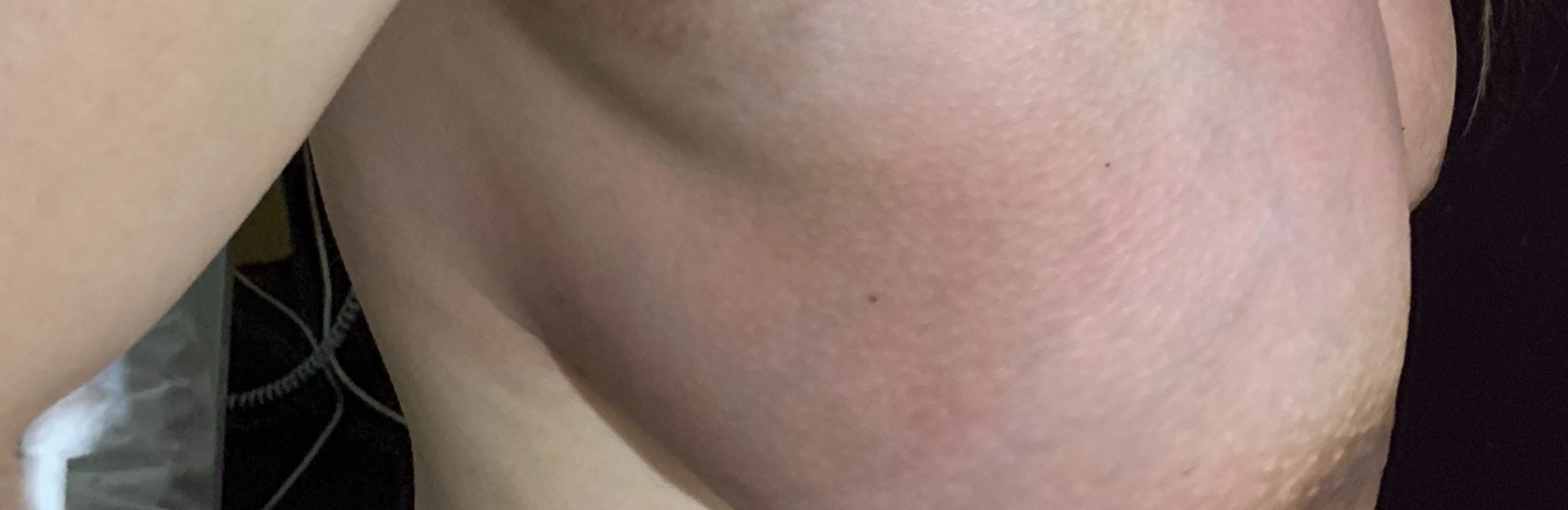 engorgement; breastfeeding; lactation; breast inflammation